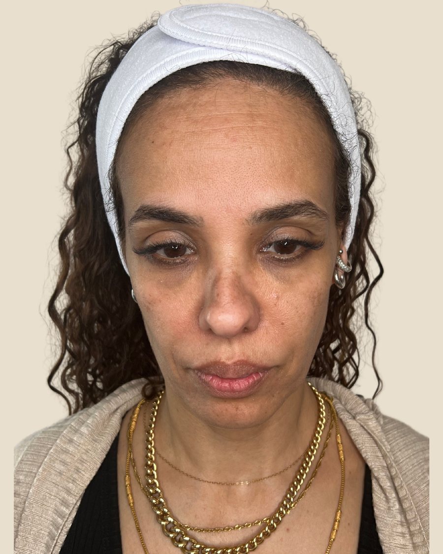 לפני הטיפול