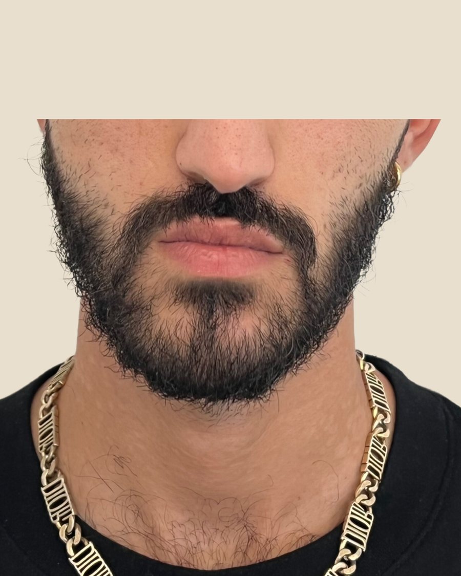 לפני הטיפול